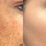 uzla'da Leke Giderme İçin Neden Veine Beauty İdeal Seçim