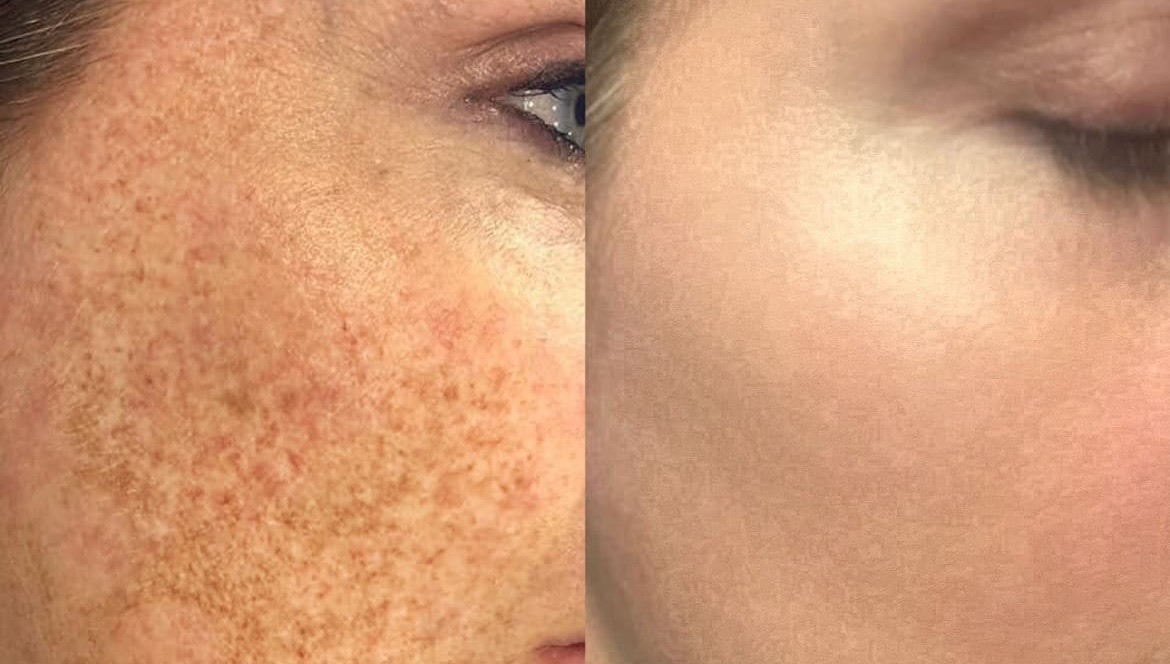uzla'da Leke Giderme İçin Neden Veine Beauty İdeal Seçim