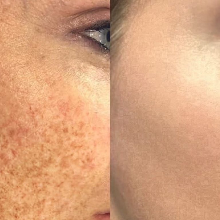 uzla'da Leke Giderme İçin Neden Veine Beauty İdeal Seçim